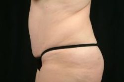 Tummy Tuck