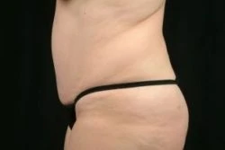 Tummy Tuck