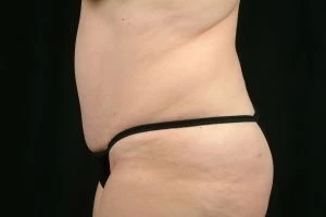 Tummy Tuck