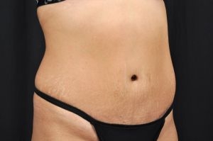 Tummy Tuck