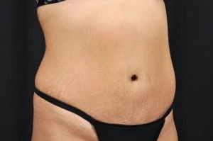Tummy Tuck