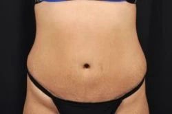 Tummy Tuck