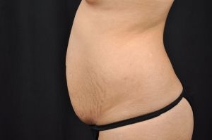 Tummy Tuck