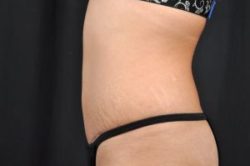 Tummy Tuck