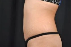 Tummy Tuck