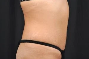 Tummy Tuck