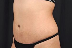 Tummy Tuck