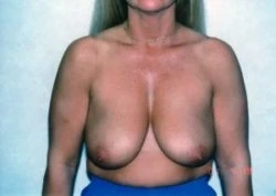 Breast Lift