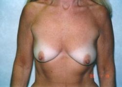 Breast Lift