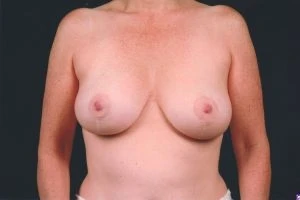 Breast Lift