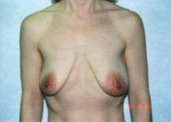 Breast Lift