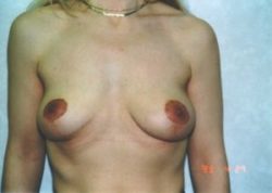 Breast Lift