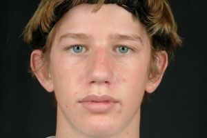 Otoplasty (Ear Tuck)