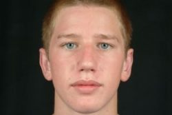 Otoplasty (Ear Tuck)