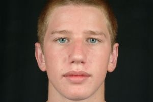 Otoplasty (Ear Tuck)