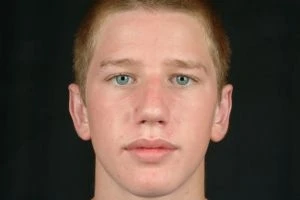 Otoplasty (Ear Tuck)