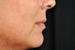 Injectable Fillers Virginia Beach