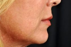 Injectable Fillers Results Virginia Beach