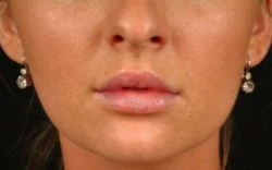 Injectable Fillers