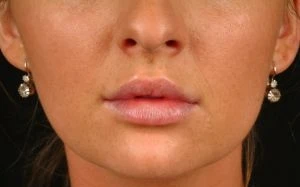 Injectable Fillers
