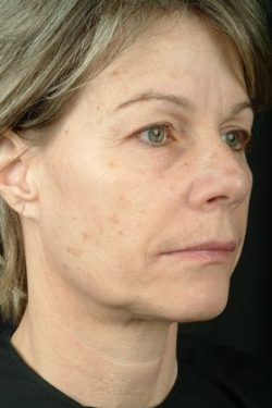 Laser Skin Rejuvenation