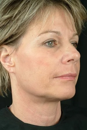 After Laser Skin Rejuvenation