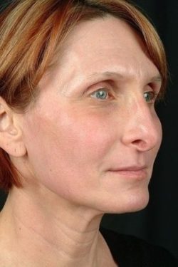 Laser Skin Rejuvenation