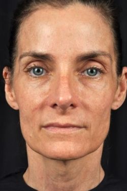 Laser Skin Rejuvenation