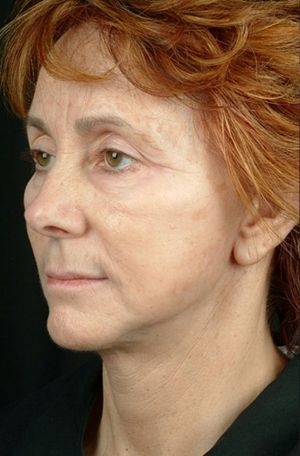 Laser Skin Rejuvenation