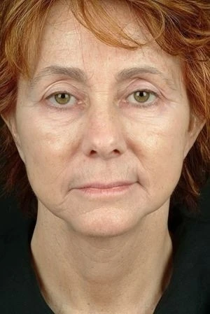 Laser Skin Rejuvenation