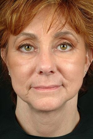 Laser Skin Rejuvenation
