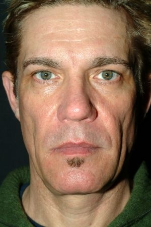 Sculptra Aesthetic Virginia Beach