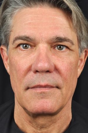 Sculptra Aesthetic Results Virginia Beach