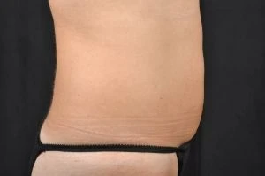 CoolSculpting