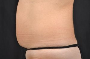 CoolSculpting