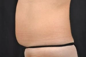 CoolSculpting