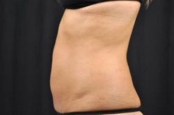 CoolSculpting