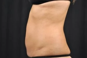 CoolSculpting