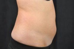 CoolSculpting
