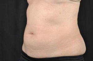 CoolSculpting