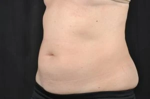 CoolSculpting