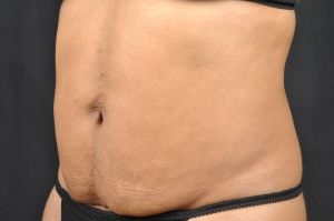 CoolSculpting