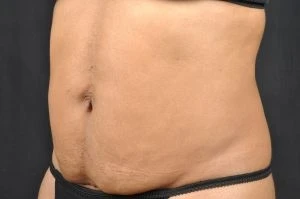 CoolSculpting