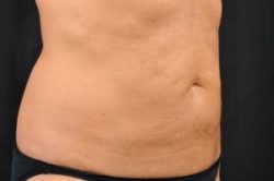 CoolSculpting