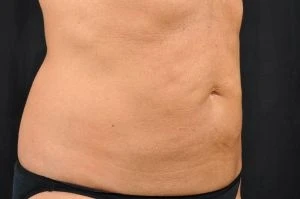 CoolSculpting