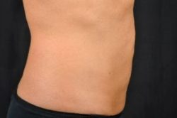 CoolSculpting