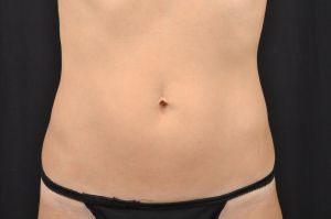 CoolSculpting