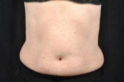 CoolSculpting