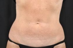 CoolSculpting