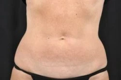 CoolSculpting